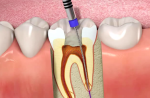 root canal on badly decayed tooth